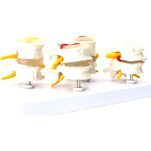 GTBL Human Anatomy Skeleton Spine 4-Stages Lumbar Vertebral Model Brain Skull Traumatic Teaching Supplies