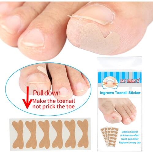 1Set Ingrown Toe Nail Correction Sticker Patch Paronychia Elastic File Wire Corrector Foot Care Treatment Groove Orthopedic Pads