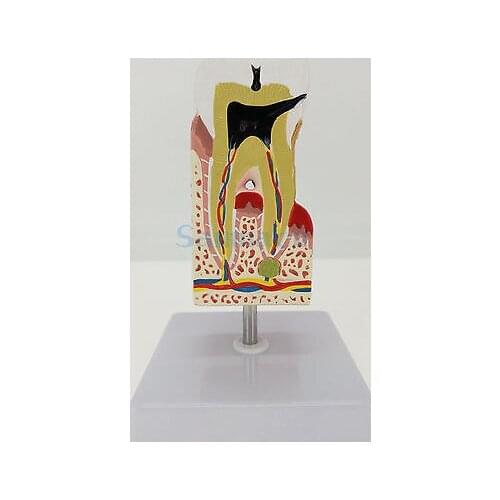 Human Diseased Teeth Anatomical Model Medical Anatomy For Patient Education