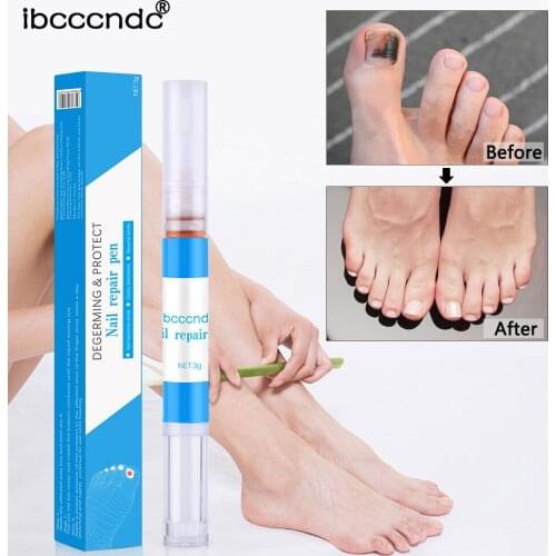 Anti Fungal Nail Repair Liquid Onychomycosis Paronychia Herbs Nail Treatment Pen Fungus Removal Nail Repair Liquid T0931