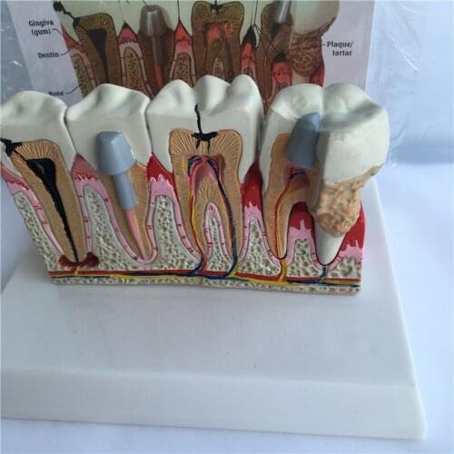 Human Tooth Common Pathologies Anatomy Model Dental Model Medicine Teaching Instrument