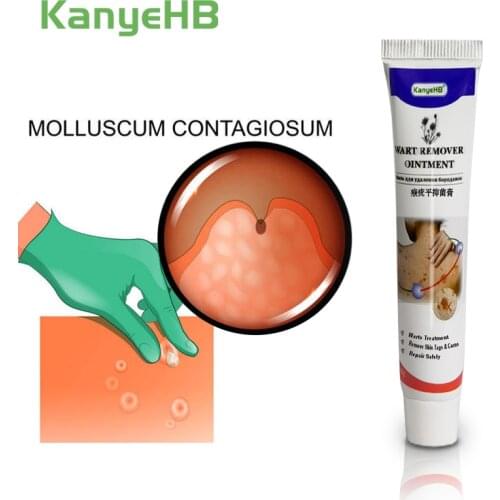 1pcs Wart Remover Ointment Genital Herpes Genital Vulva Condyloma Acuminatum Skin Tag Remover Antibacterial Treatment Cream G001
