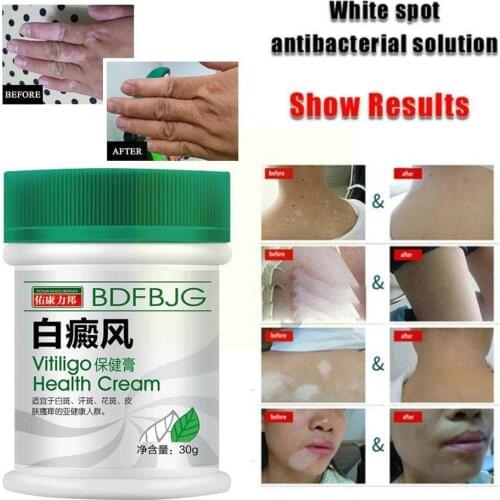White Spot Treatment Ointment Leukoplakia Disease Repair Chinese Cream Body Health Melanin Pigment Care Vitiligo Medical Cr K7O1