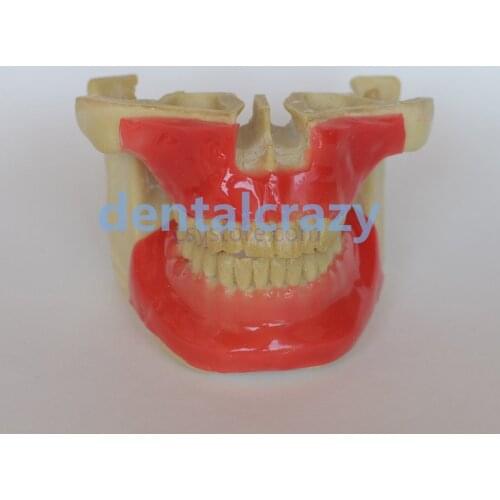 NEW Dental Model #203101 Orthodontic Anchor Implant Screw Practice Model with Tissue