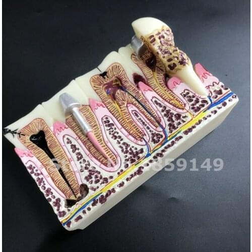 Dental Anatomy of dental caries plastic teeth model demonstration communication