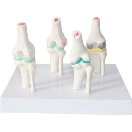 Human anatomical model 4 stages pathological change knee joint model