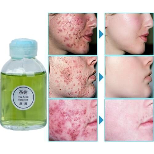 Tea Tree Cleansing Acne Essential Oil Shrink pores Face Anti acne Treatment Cream Moisturize Nutrition Control Oil Smooth Skin