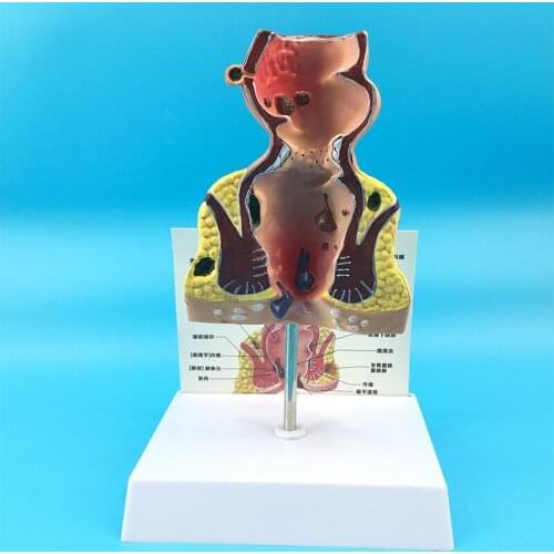 Pathological Model of Hemorrhoids Anorectal Teaching Anatomy Model - Anorectal Pathology Model