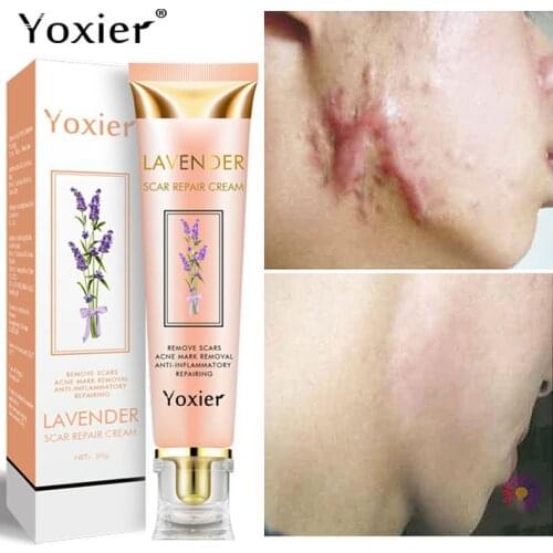 Yoxier Lavender Acne Scar Repair Cream Scar Removal Pigmentation Corrector Remove Stretch Marks Smooth Skin Whitening Scar Care
