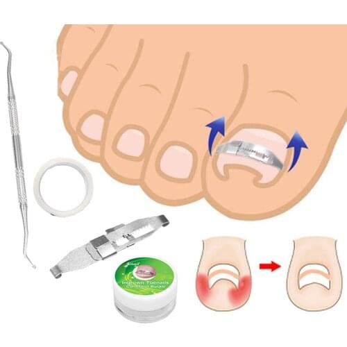 1Set Ingrown Toenail Correction Tool Ingrown Toe Nail Treatment Inset Buckle Pressure Sensitive Tape Twillizer Pedicure Tool