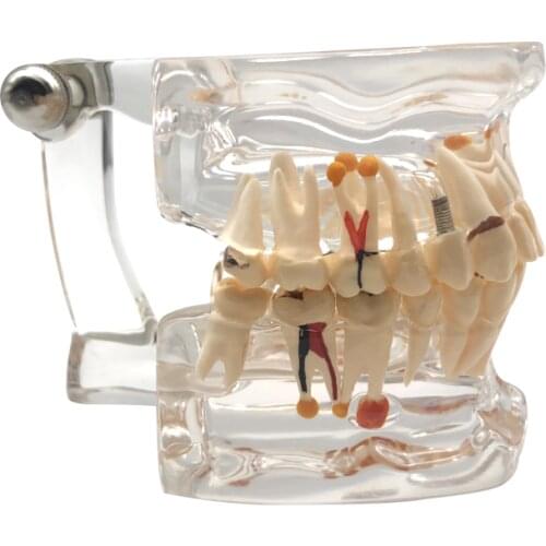 Dental Implant Disease Teeth Model With Restoration Bridge Tooth Dentist For Medical Science Dental Disease Teaching Study