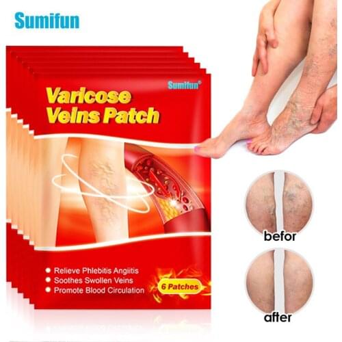 6/12/30pcs Varicose Veins Treatment Angiitis Removal Patch Vasculitis Phlebitis Spider Leg Herb Medical Plaster Leg External Use