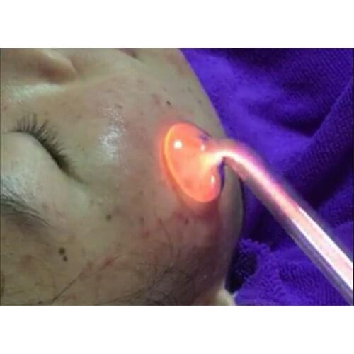 Handle High Frequency Stick Acne Therapy Spa Spot Removal Device Beauty Care Anti-inflammation Cosmetic Tool for home use