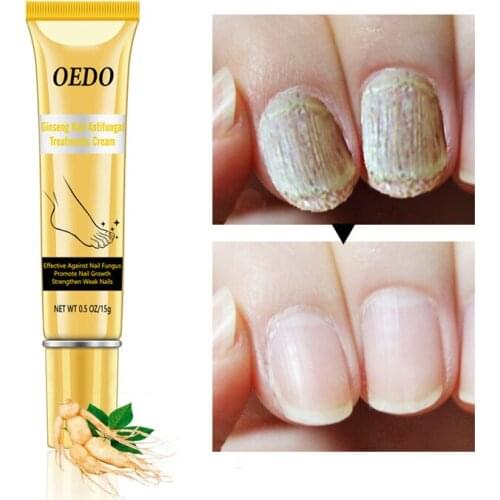 Ginseng Nail Antifungal Treatments Cream Accelerate Nails Growth Repair Nails Cream Improve Nails Tissue Anti Onychomycosis Gel