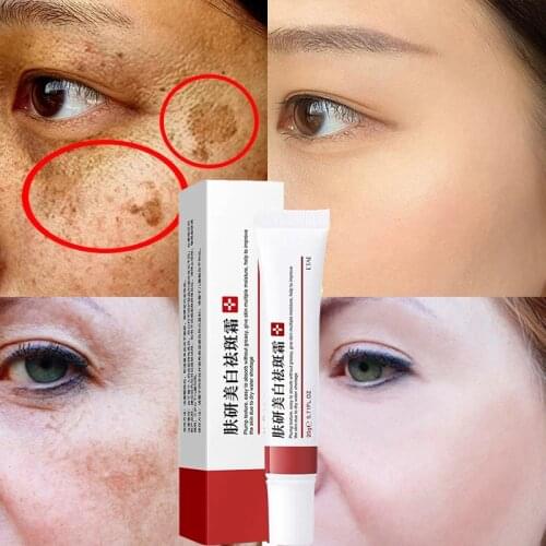 Whitening Freckle Cream Remove Melasma Acne Spot Pigment Melanin Dark Spots Pigmentation Freckle Removal Cream Moisturizing Gel