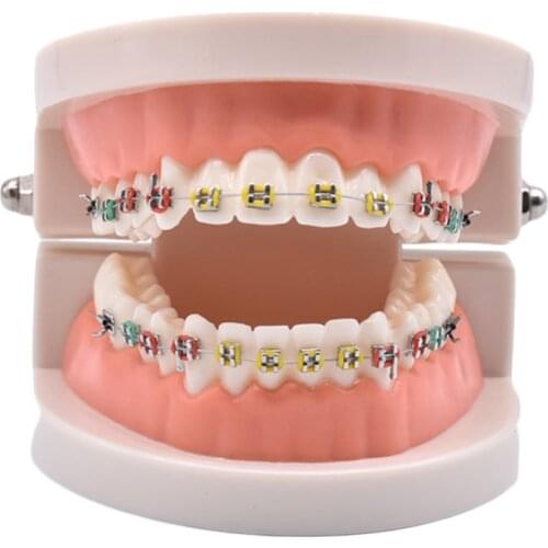 Dental Orthodontic Treatment Model With Ortho Metal Ceramic Bracket Arch Wire Buccal Tube Ligature Ties Dental Tools Dentist Lab