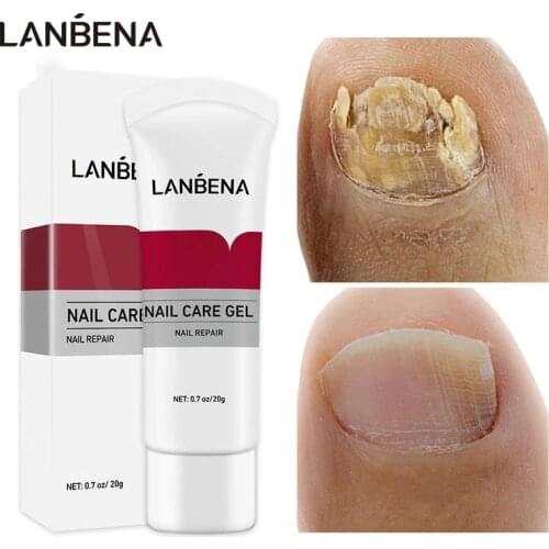 LANBENA Fungal Nail Treatment Gel Repair Nail Remove Onychomycosis Anti-Infection Nail Fungus Removal Effective Soften Nail Care
