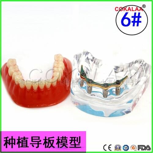 12 type Resin Coverage dental implant model dentures Removable teeth model