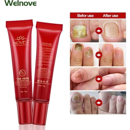 1Pcs Fingers Feet Nail Anti Fungi Treatment Ointment Onychomycosis Paronychia Herbal Repair Cream Nail Fungus Infection Plaster