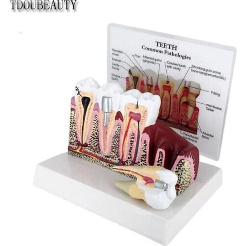New Dental Pathology Teaching Model, Dental Calculus, Tooth Decay, Pathology, Gingival Inflammation, Planar Model.Free Shipping