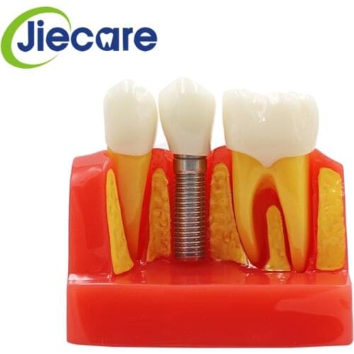 1 PC Dental Material Dental 4 Times Teeth Implant Model Disease Teeth Model With Restoration Bridge Crown For Medical Study
