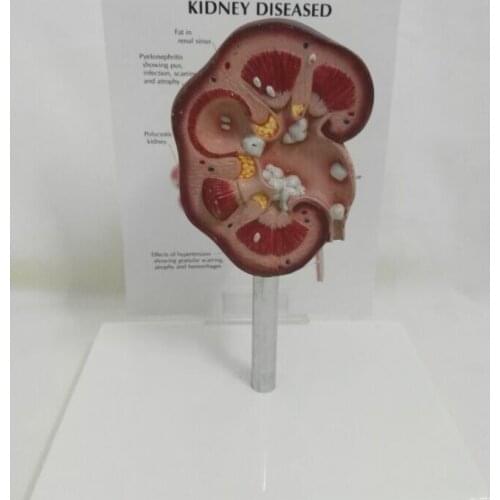 Pathological kidney anatomical model Kidney anatomy teaching aid diseased kidney