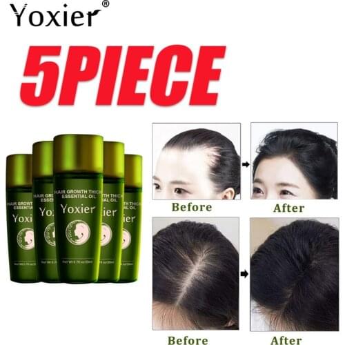 Yoxier Herbal Hair Growth Essential Oil Hair Loss Treatment Effective Rapid Growth Growth Serum For Men Women Hair Care Product