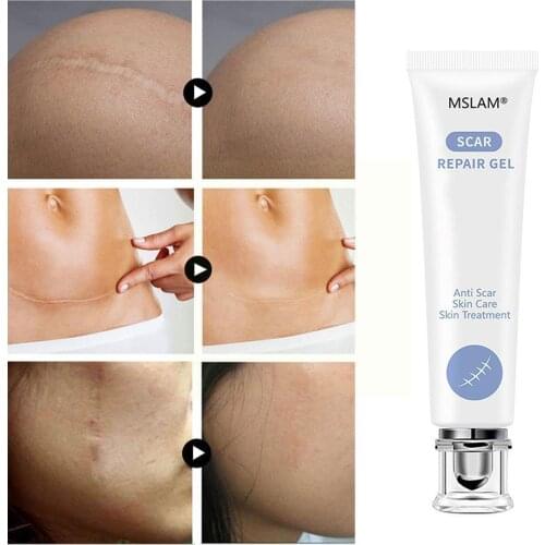 Repair Gel Removal Scar Acne Cream Treatment Face Body Texture Skin Pigmentation Cream Corrector Mild Quickly Heal Removal V9W7