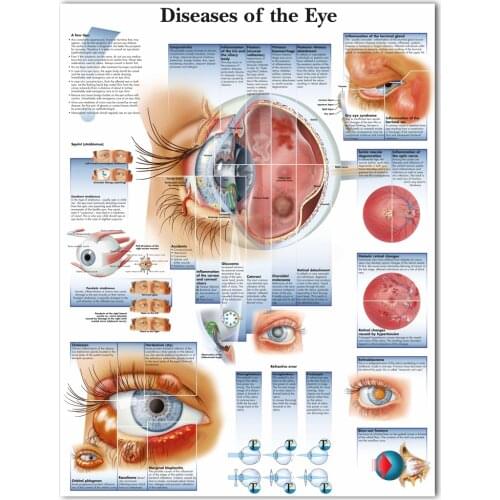 WANGART Poster Diseases of the Eye Chart Posters Refractiv Canvas print Wall Pictures for Medical Education Home Decor
