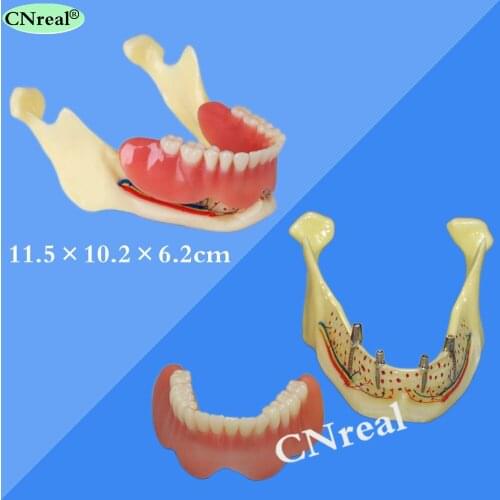 1 Piece Mandible Implant Teeth Model for Dental Teaching Dentist Lab Demonstration