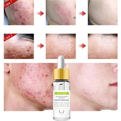15ml VIBRANT GLAMOUR Tea Tree Repair Face Serum Acne Shrink Pores Repair Moisturizing Repair Skin Care