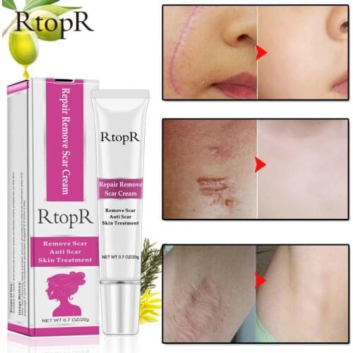 20g Scar Removal Cream Face Acne Scar Stretch Marks Remover Cream Skin Repair Face Cream Acne Spots Face Cream