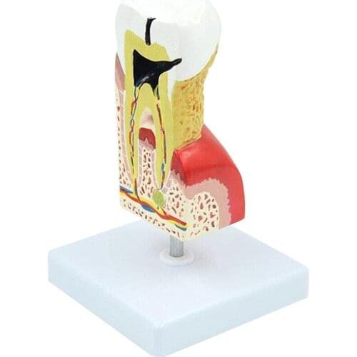 Human Pathological Dental Model Dental Anatomical Model Human Tooth Dental Caries Pathologies Anatomy Model Medicine Teaching