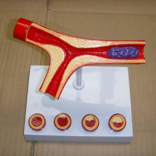 Human Vessel Anatomical Model Atherosclerosis Model for Medical Training Model