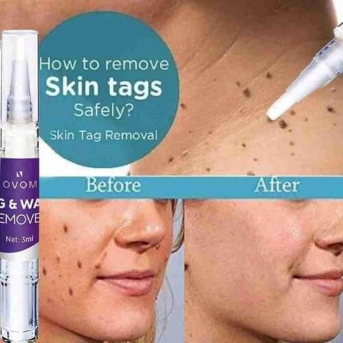 Skin Tag Remover Warts Remover Liquid Pen Wart Treatment Cream Herbal Extract Foot Corn Plaster Acne Warts Ointment Skin Care