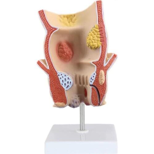 Simulated rectal pathology model intestinal specimens human anatomical model hemorrhoids anal pathology medical teaching aid