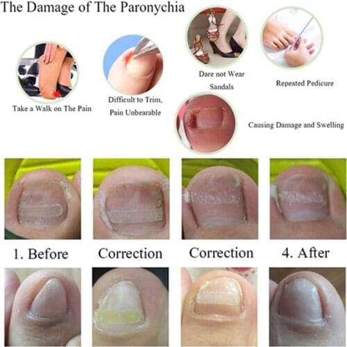 Pedicure Kits Ingrown Toenails Correction Brace Toenail Patch Grinding w/ Glue