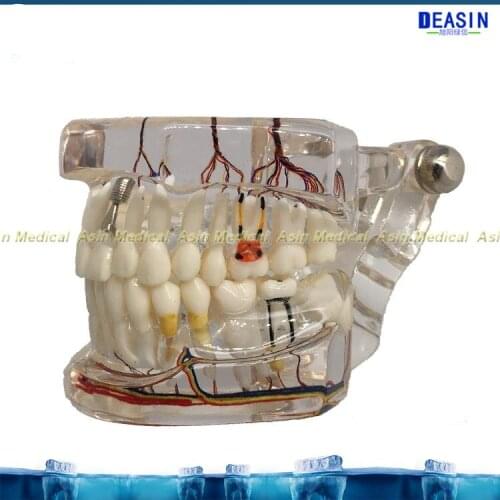 New dental implant teeth model with nerve Transparent pathological Repair model Teaching demonstration model