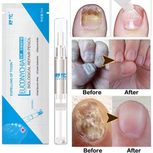 3ml Fungal Nail Pen Effective Onychomycosis Paronychia Fungus Infection Repair Solution Gel Toenail Treatment Nutrient Essence