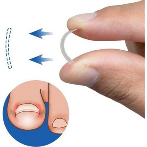 Transparent Ingrown Toenail Correction Clip Ingrown Toenail Elastic Patch Sticker Straightening Brace Curved Brace Pedicure Tool