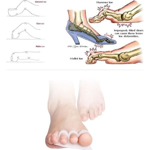 Hallux valgus orthosis finger overlap hammer toe correction correction pad beetle crusher bone hallux valgus toe separator