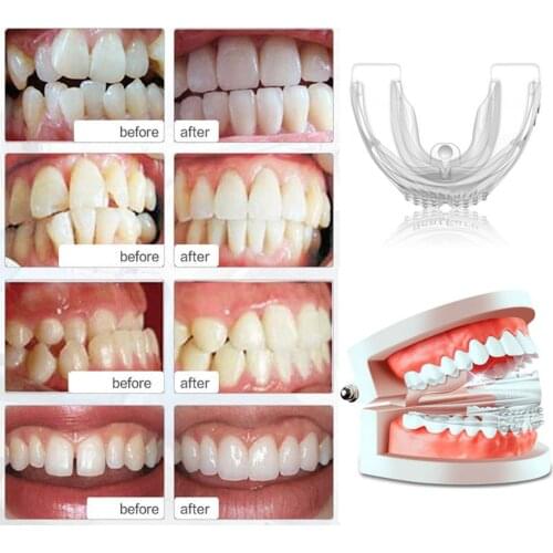 Orthodontic Braces Appliance Dental Braces Silicone Alignment Trainer Teeth Retainer Bruxism Mouth Duard Teeth Straightener