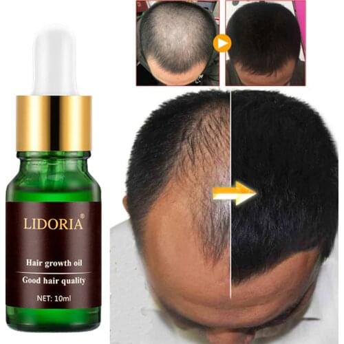 Средства для роста волос CZLMI China At AliExpress