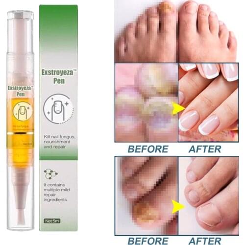 2021 Hot Fungus Nail Treatment Feet From The Fungus Nail Repair Cream Nail Care Foot Toe Gel Anti Repair Wholesale Drop TSLM1