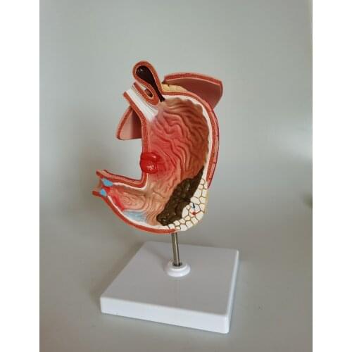 Gastric pathology model, gastric cancer model, gastritis model