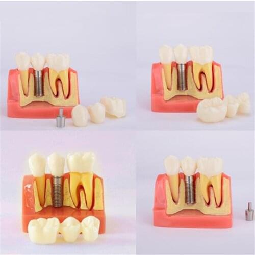 Dental Teeth Model Dental Teach Implant Analysis Crown Bridge Demonstration Coummnication Teeth Model