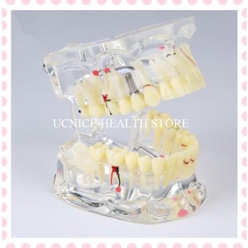 Dental Implant Disease Teeth Model M4001/Dental Study Tooth Transparent Adult Pathological Teeth Model/ Implant Disease Model