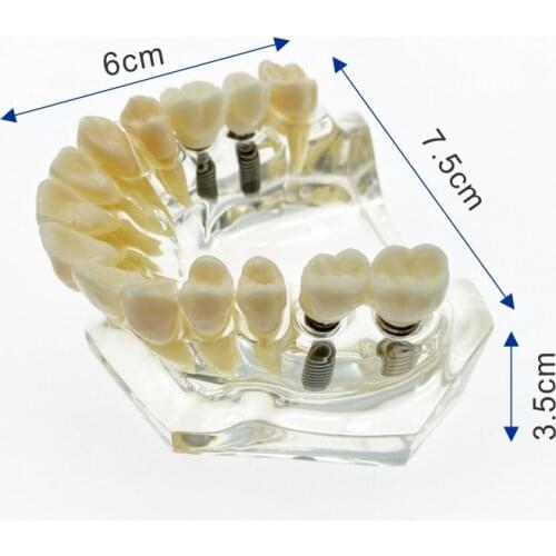 Dental Implant model Upper/Lower jaw with bridge and caries teeth model