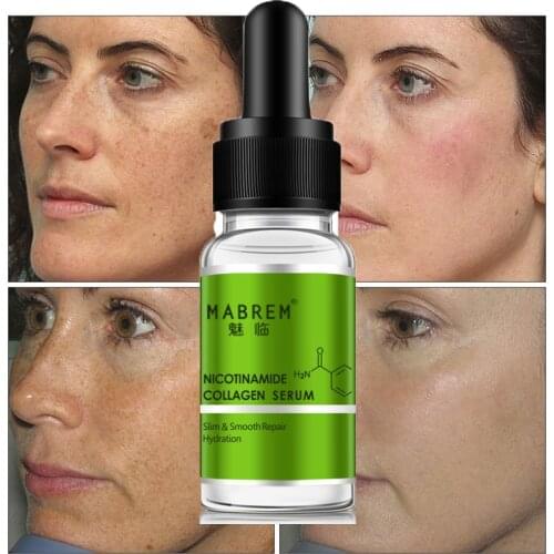 Nicotinamide Repair Serum Deep Moisturizing Anti-Inflammatory Anti Redness Hyaluronic Remove Freckle Face Skin Care Essence 10ml