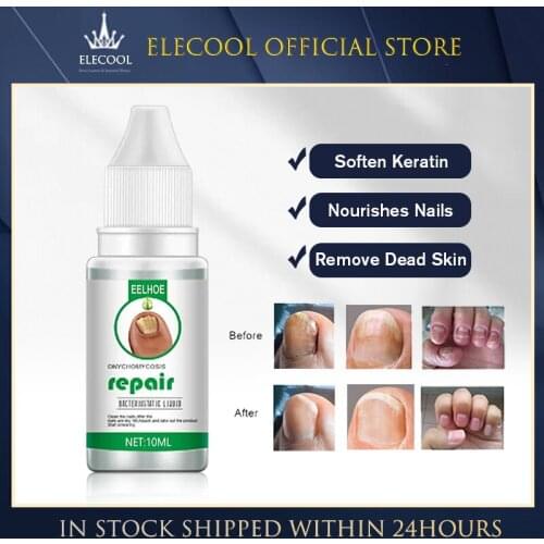 10/20/30ML Onychomycosis Repair Liquid Paronychia Nail Toe Fungus Foot Repair Nail Repair Supplies TSLM1
